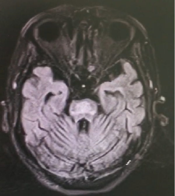 美(měi)格醫學助力罕見病檢出——自免性GFAP星形膠質細胞病