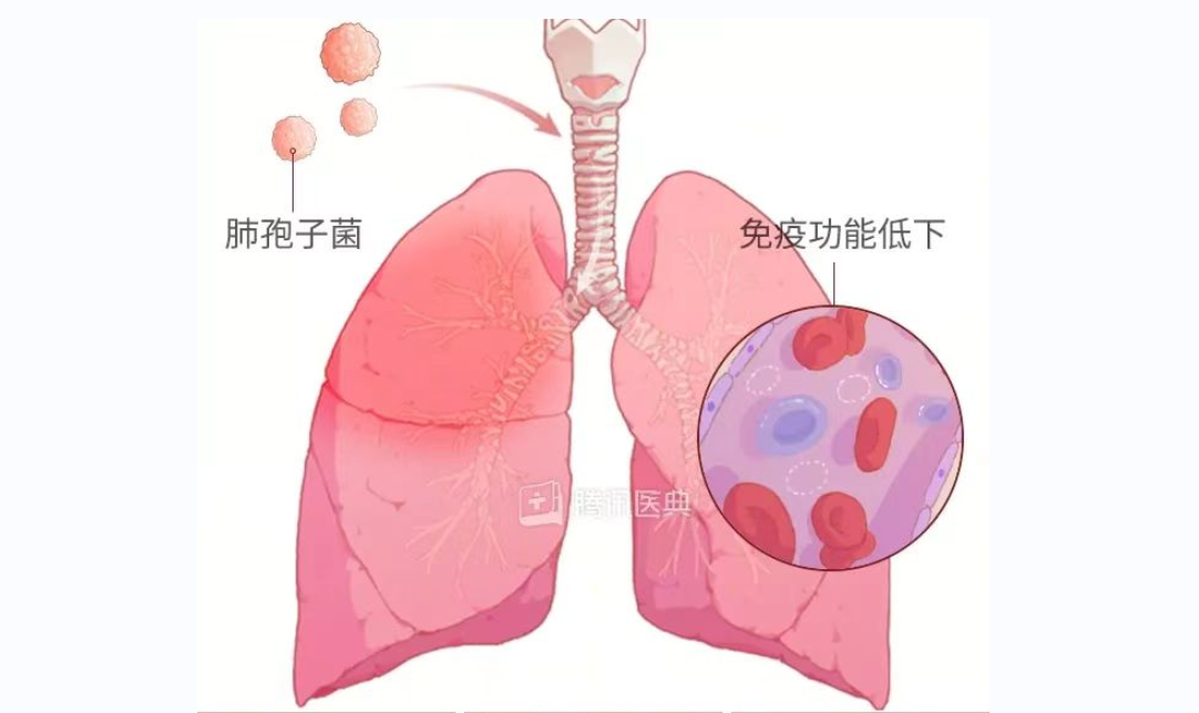 耶氏肺孢子菌肺炎—— 作爲免疫缺陷病患者的(de)常客，緻死速度必須警惕！