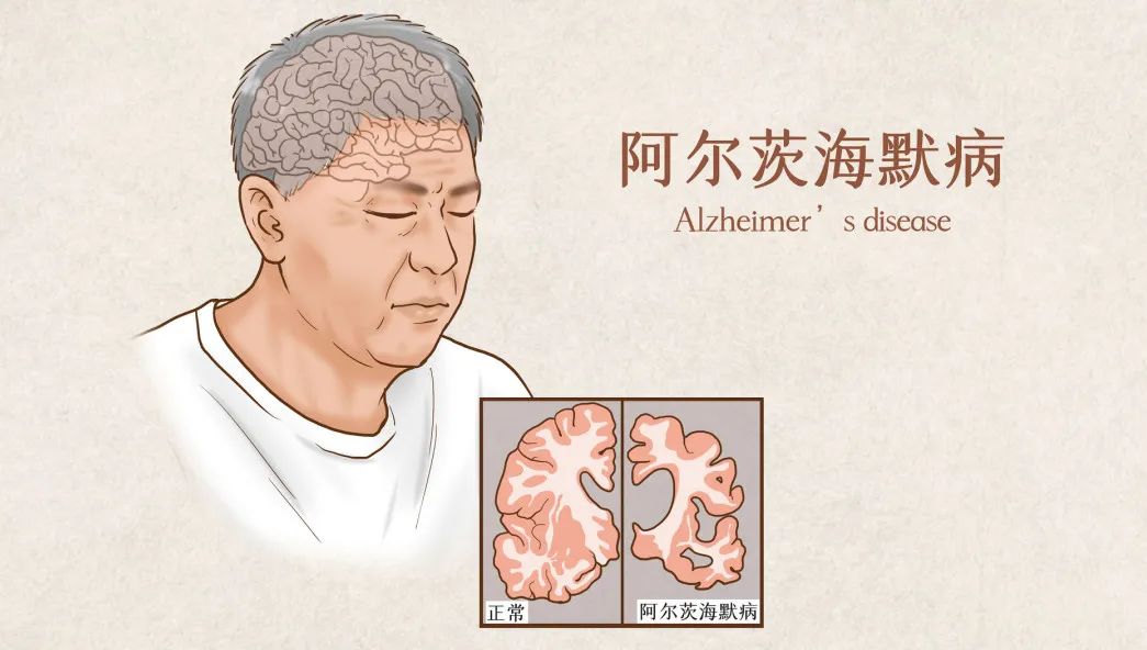 新品預告 | 利用(yòng)基因檢測守護記憶，預防老年癡呆，提早行(xíng)動更安心
